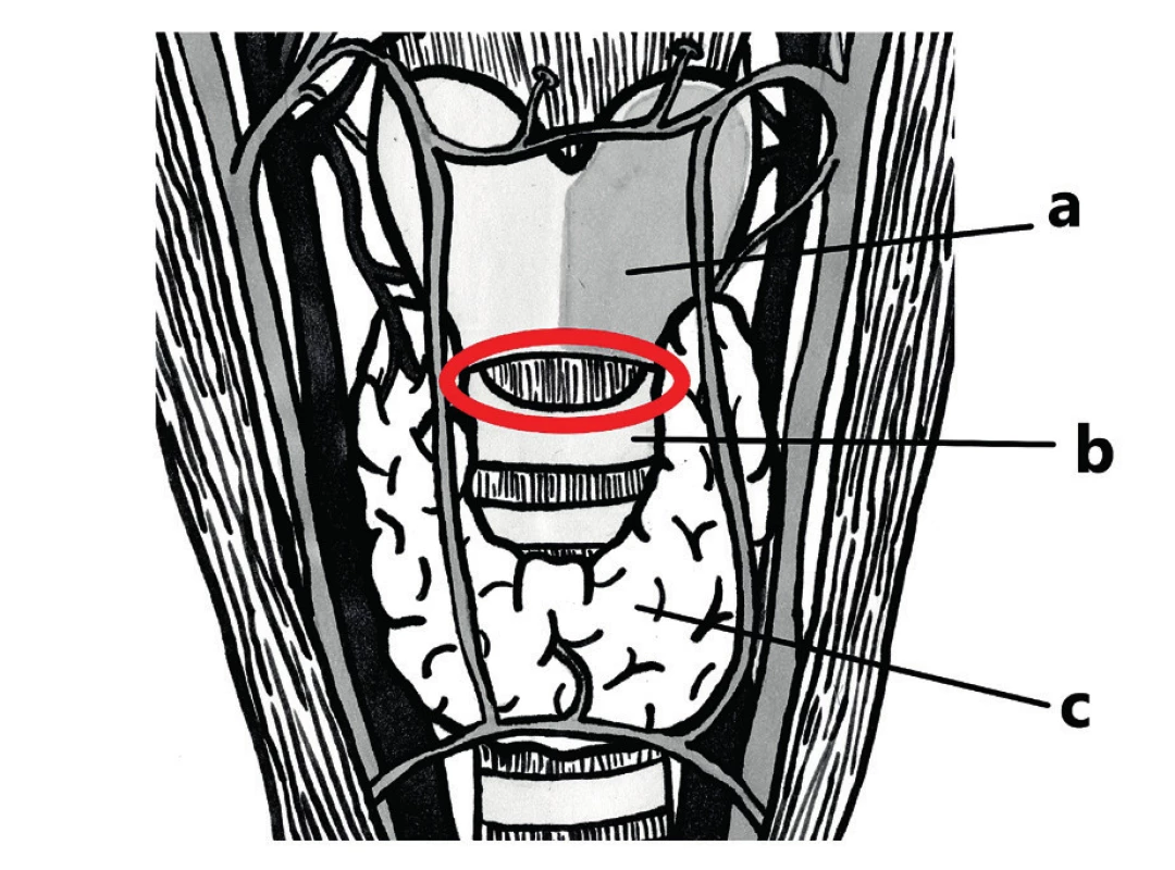 Topografická anatomie pro koniotomii (místo
zavedení červeně)