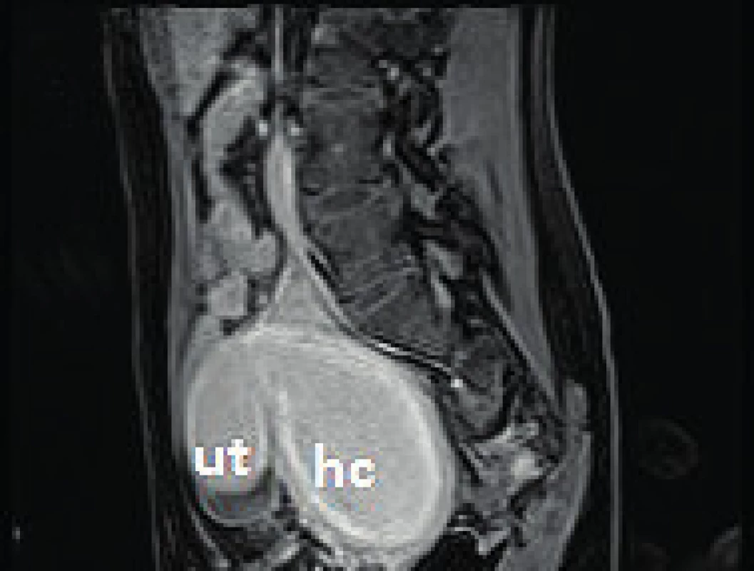 MRI snímek pánve T1 s kontrastem v sagitální projekci
ut – uterus, hc – hematokolpos