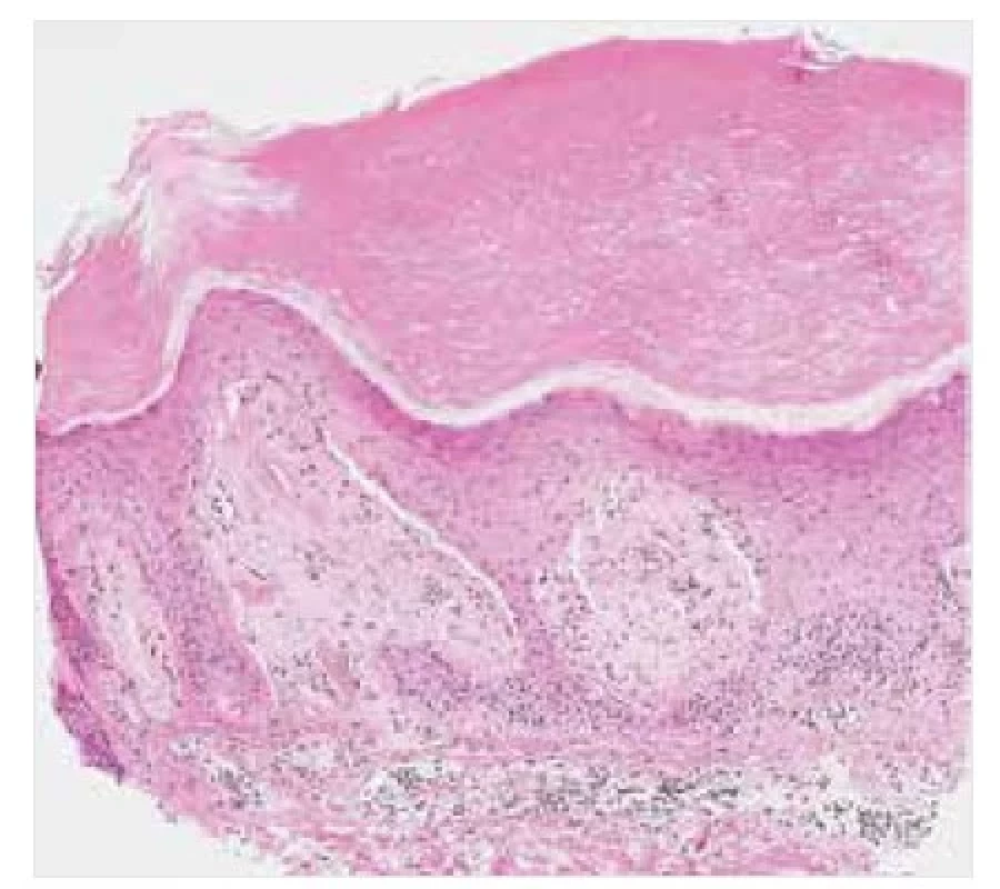 Lichen amyloidosus – histopatologie<br>
Barvení HE, původní zvětšení 100krát.