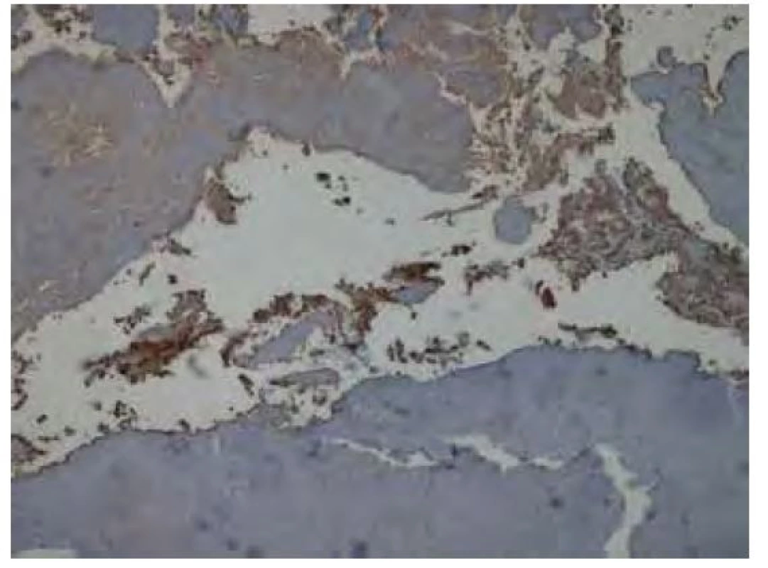 Imunohistochemické vyšetření v reakci s protilátkou proti
lehkým Ig kappa bez jednoznačné pozitivity v oblasti amyloidových depozit.
Pozitivitu vykazuje část okolní plazmocelulární populace. Původní
zvětšení snímku 40x