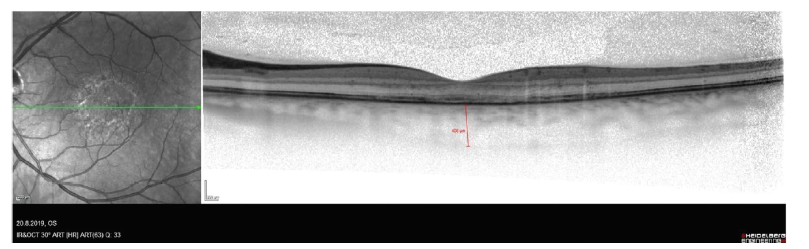 Snímek optické koherenční tomografie pacienta s chorioretinitidou se snížením reflexivity vrstvy retinálního pigmentového
epitelu a zesílení cévnatky
