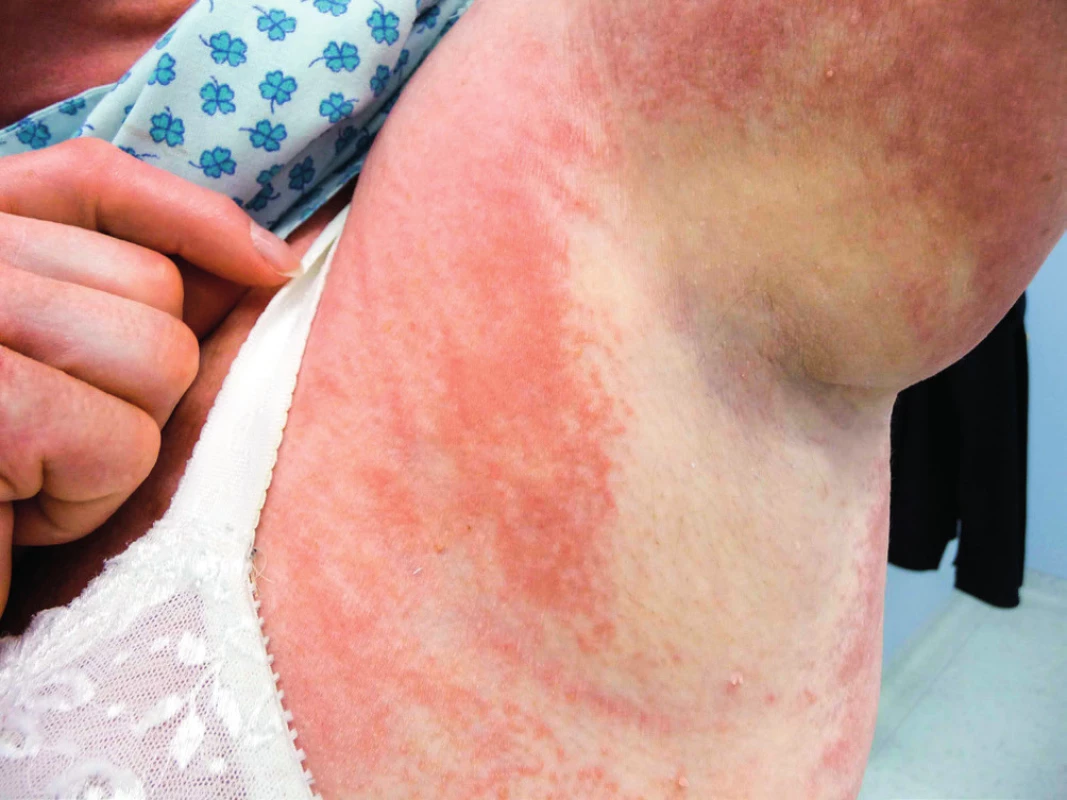 Mramorovaná kůže pacientky se skleromyxedémem: místy
bledá, místy lividní
