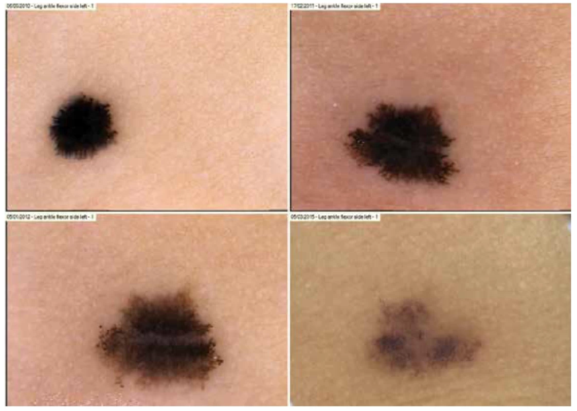 Vývoj dermatoskopického nálezu v průběhu 5 let u Reedova névu – ponechán bez excize na kůži dolní končetiny
dítěte předškolního věku<br>
Dermatoskopický nález se postupně vyvíjí od běžného Reedova névu přes obraz napodobující melanoma in situ až
do klidného involvujícího běžného melanocytového névu. Projev postupně ztrácí veškeré dermatoskopické
znaky
névu Reedova.
