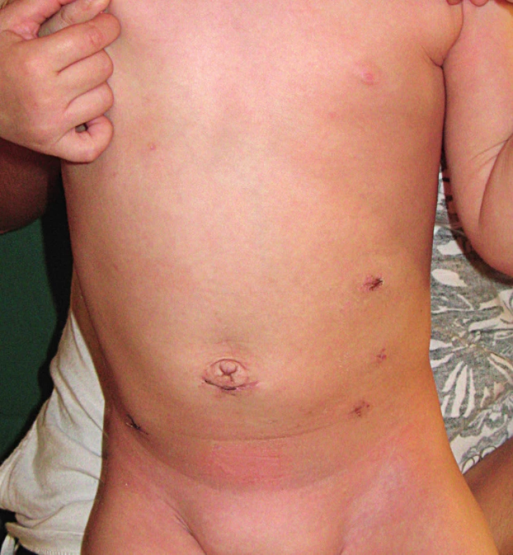 Výborný kozmetický efekt po minimálne invazívnom
zákroku.<br>
Fig. 9. Excellent cosmetic effect after minimally invasive
surgery.