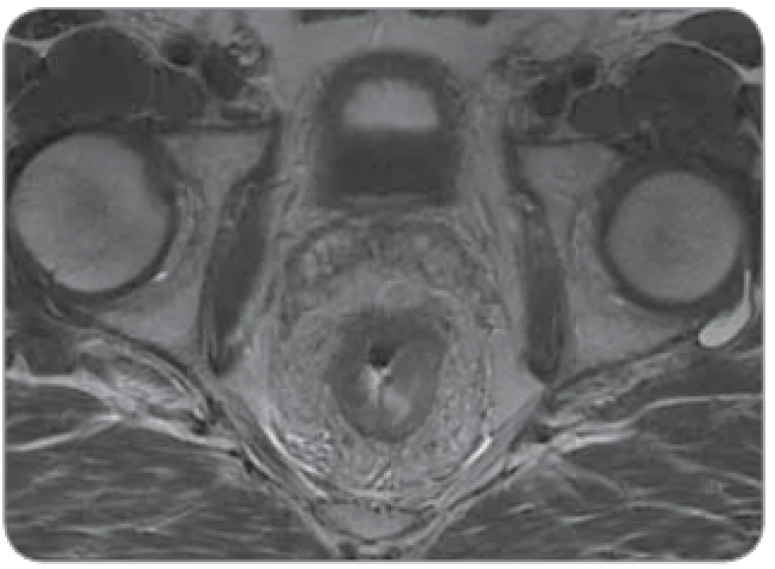  „Bad“ tumor u mužského pacienta,
nádor v 5 cm infi ltrující mezorektální tuk
s těsným vztahem k fascia recti a semenným váčkům.