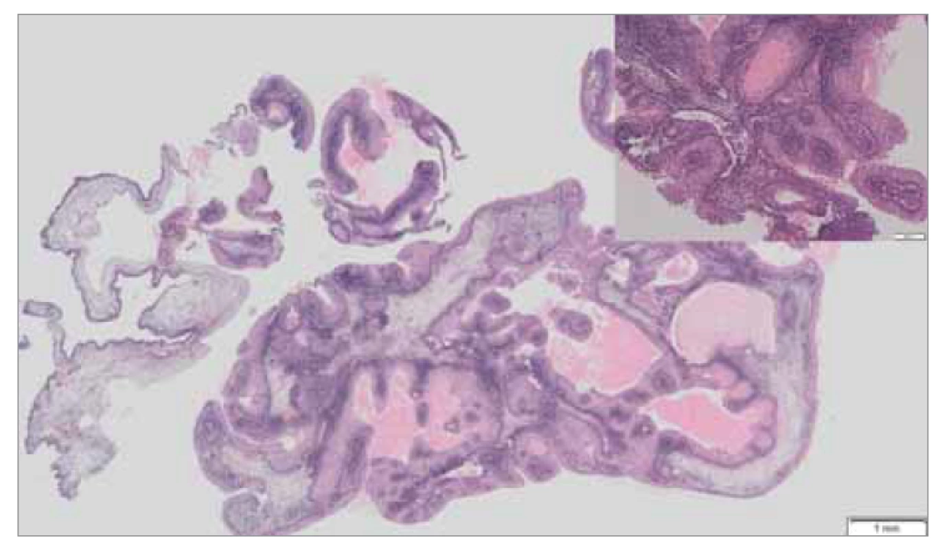 Histologické vyšetření, barvení hematoxylin-eozin, zvětšení 4x, papilárně
utvářený tumor s exofytickým a endofytickým (invertovaným) typem
růstu tvořený dlaždicovým epitelem s dyskeratózou, s ojedinělými mucinózními
buňkami, s reaktivními změnami epitelu, vazivové stroma je prostoupeno
zánětlivou celulizací.<br>
Fig. 4. Histological examination, hematoxylin-eosin staining, magnification 4x,
papillary tumor with exophytic and endophytic (inverted) growth type consisting
of squamous epithelium with dyskeratosis, with isolated mucinous cells, with reactive
epithelial changes, fibrous stroma is permeated by inflammation.