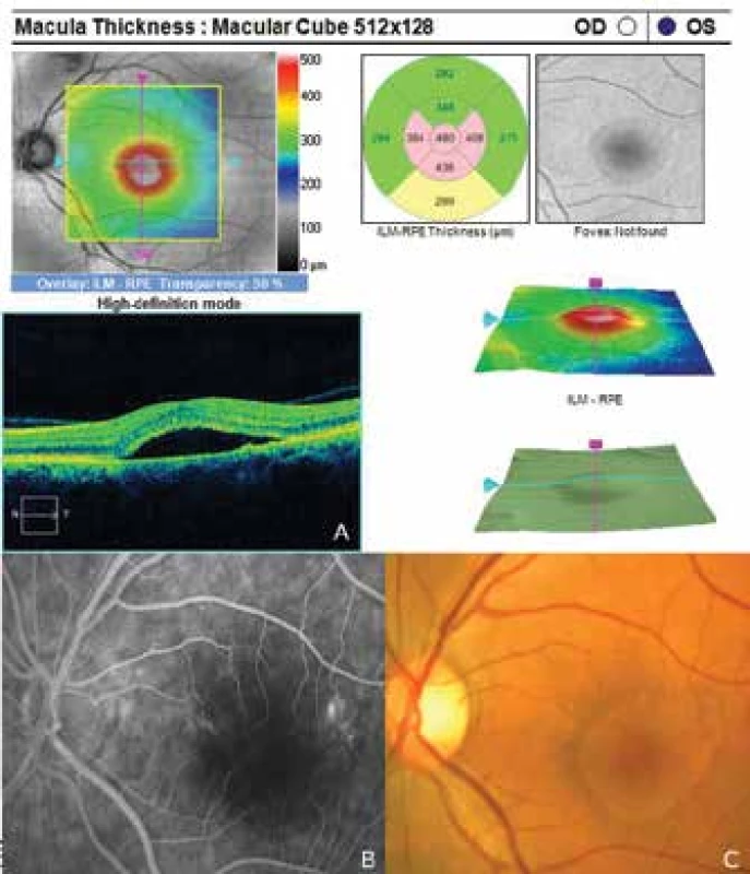 Signs of central serous chorioretionpathy of the left eye