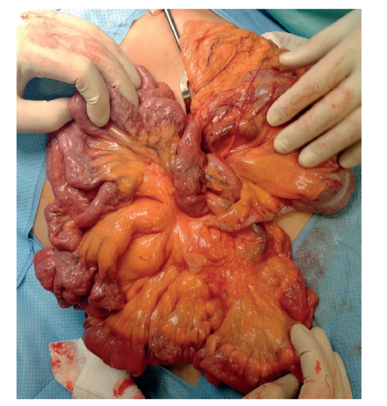 Laddovy pruhy – operační nález<br>
Fig. 3: Ladd‘s bands – surgical finding