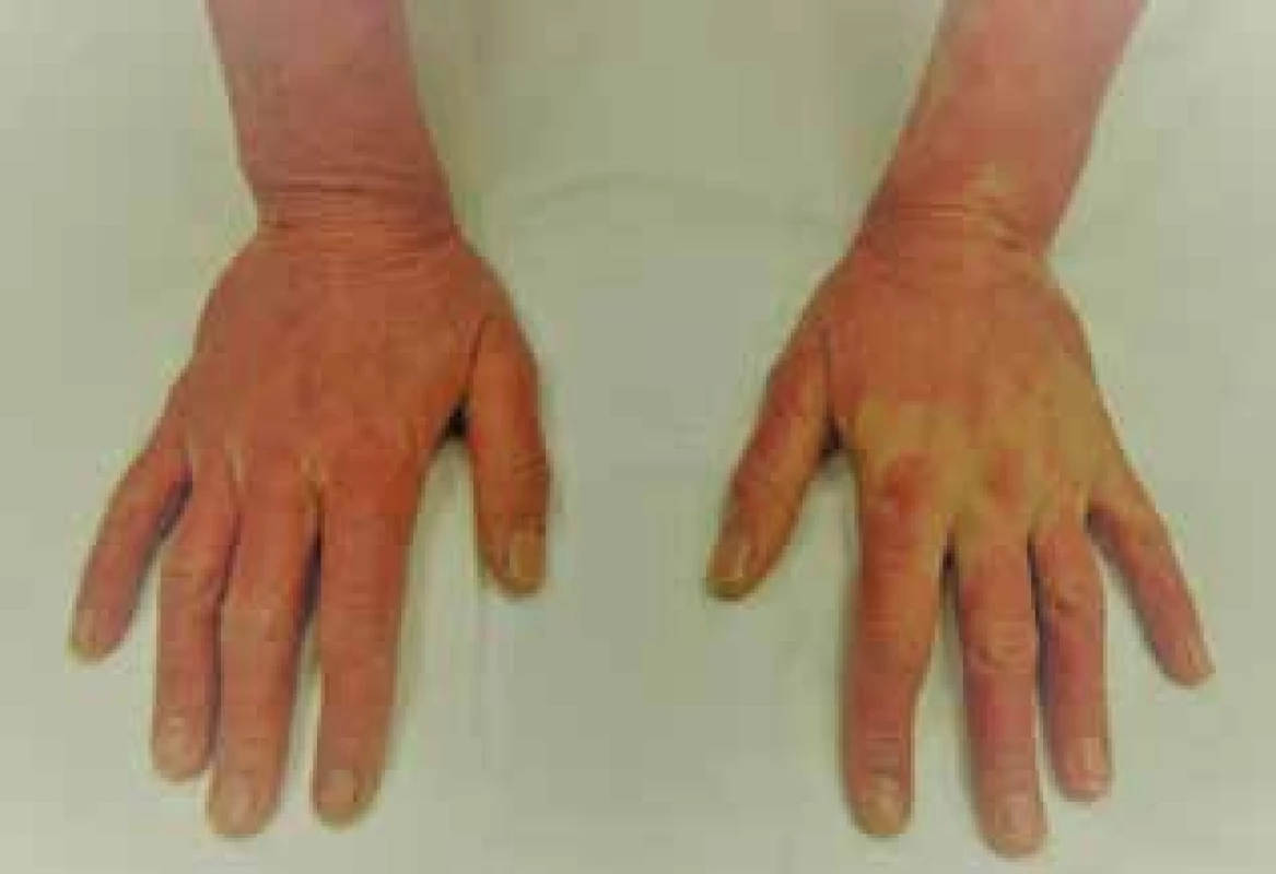 Eczema contactum allergicum manum (tiskárna – UV
tvrzené akrylátové barvy)