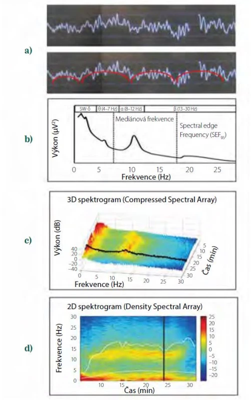 Transformace syrové EEG křivky do dvourozměrného spektrogramu.
a) syrová EEG křivka v jedné epoše, b) zjednodušené schéma Fourierovy
transformace syrové EEG křivky na dvě sinusoidy, červená s pomalou frekvencí,
bílá s rychlejší frekvencí, c) výkonové spektrum epochy, vyznačena
mediánová frekvence a frekvence spektrálního okraje (SEF95), tj. frekvence,
pod nimiž je 50 %, resp. 95 % výkonu, d) trojrozměrný spektrogram, v němž
jsou jednotlivá výkonová spektra řazena v čase odzadu dopředu, výkon (dB)
je na ose y a současně je vyznačen barevně, e) dvourozměrný spektrogram,
v němž je čas na ose x, frekvence na ose y a výkon (dB) kódován barevně