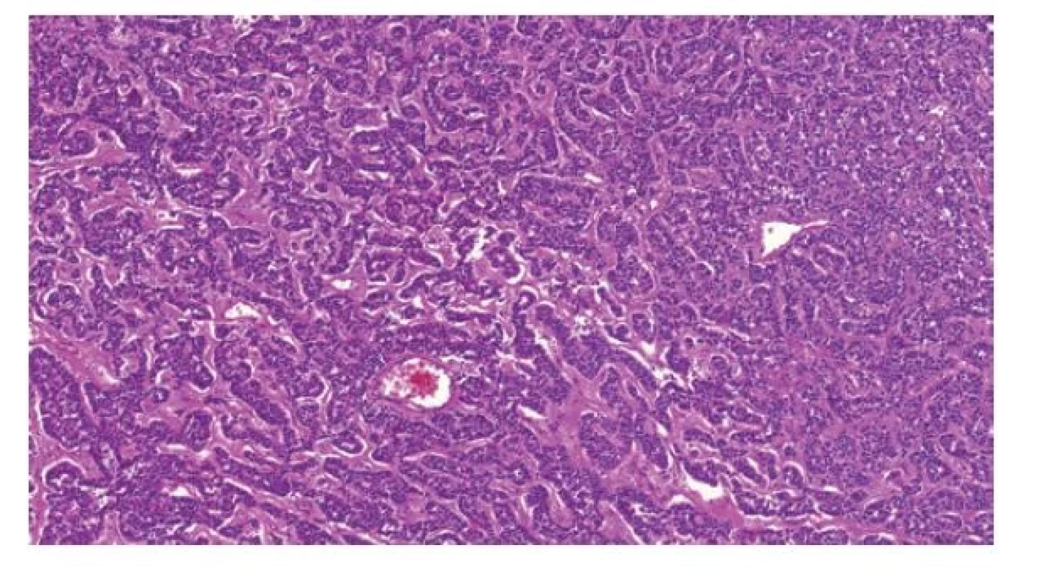 Testikulární neuroendokrinní tumor prepubertálního typu je histologicky
identický neuroendokrinním tumorům gastrointestinálního traktu.