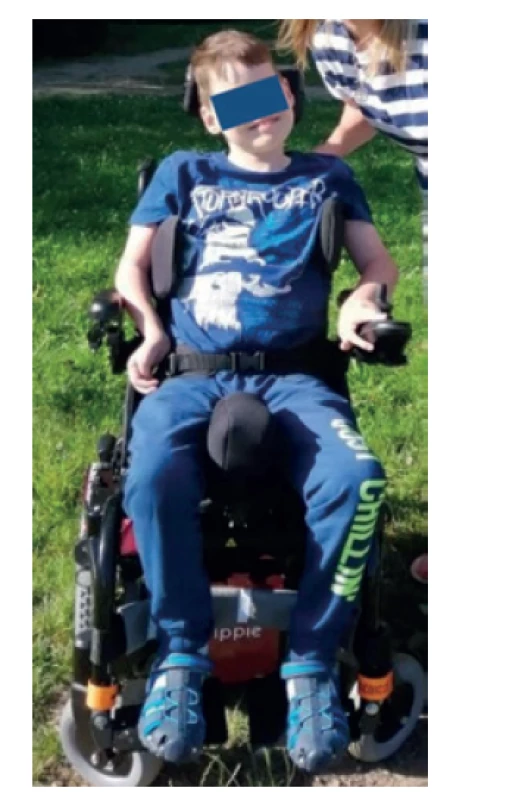 Chlapec ve věku 8 let na elektrickém vozíku. Objektivně patrná lehká
faciální stigmatizace, dystrofický habitus, četné kontraktury horních i dolních
končetin.