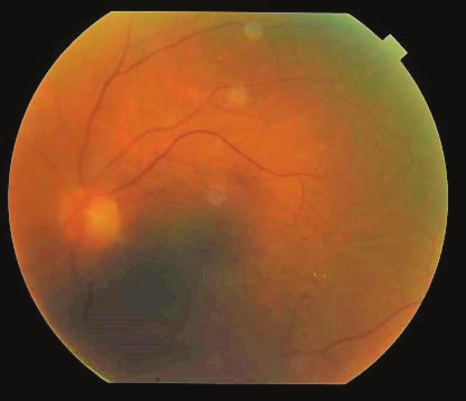 Finding on ocular fundus of left eye 8 weeks after
commencement of therapy, minimal exudation in vitreous
body