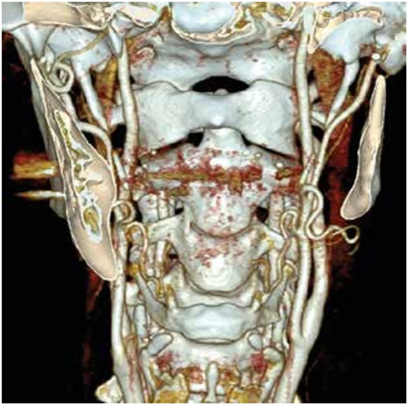 CTAg obraz karotického řečiště po 3 měsících <br>
Fig. 5. CTAG image of the carotid vessels after 3 months
