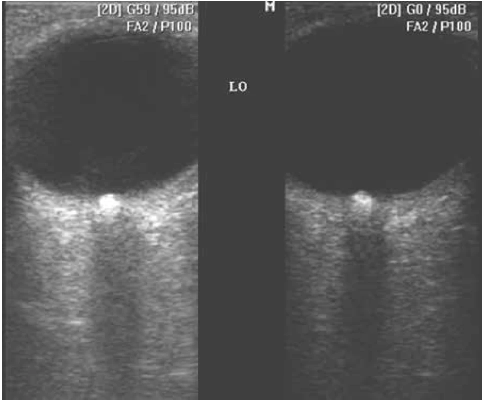 Vľavo: Drúzy optického nervu B-scan ultrasonografie v štandardnom
móde - gain 59 dB. Vpravo: “halo” efekt drúz optického nervu je minimalizovaný
(drúzy sa zobrazia v skutočnej veľkosti), ak gain znížime na 0 dB