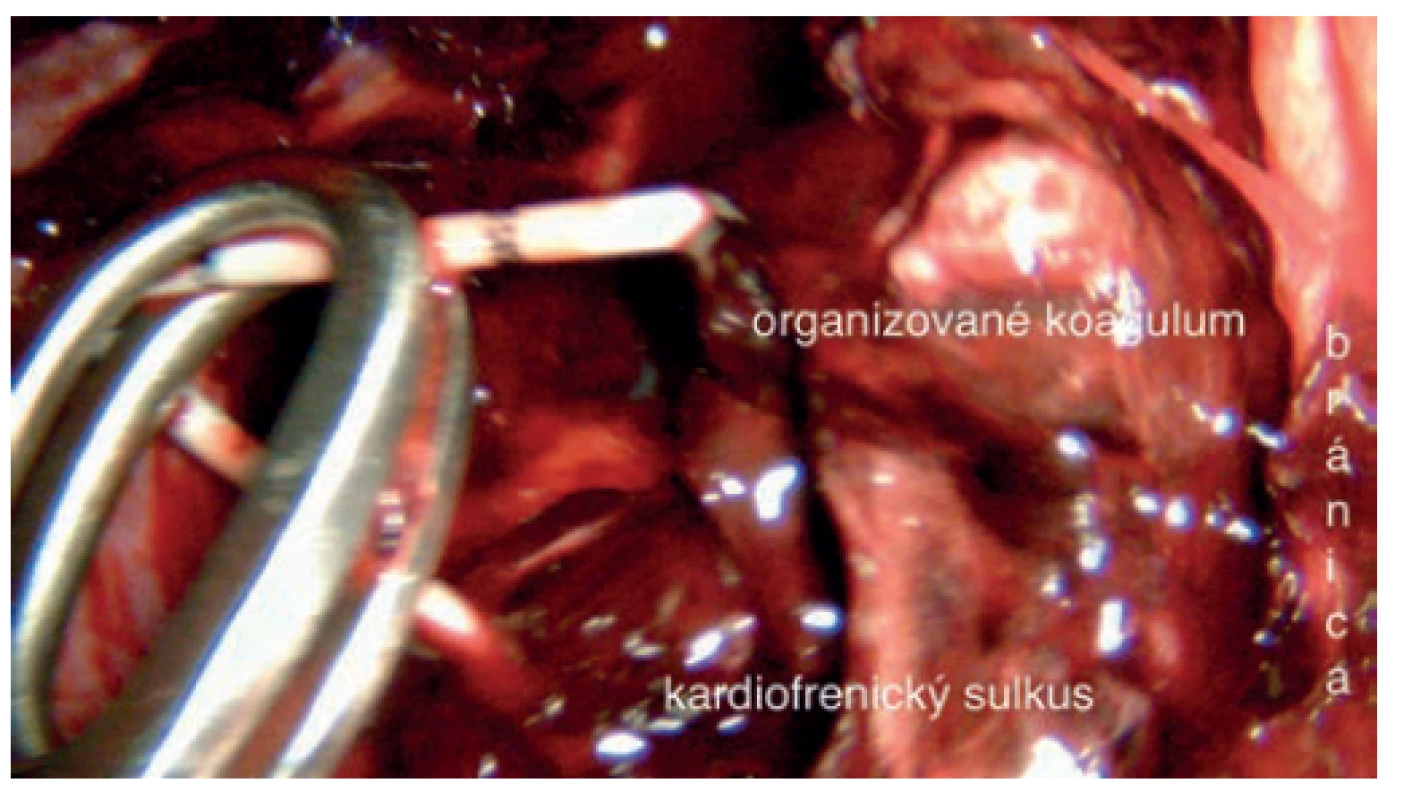 Zalomený zvyšok ablačného katétra pri VATS revízii<br>
Fig. 2. Bent remnant of an ablation catheter found during
VATS