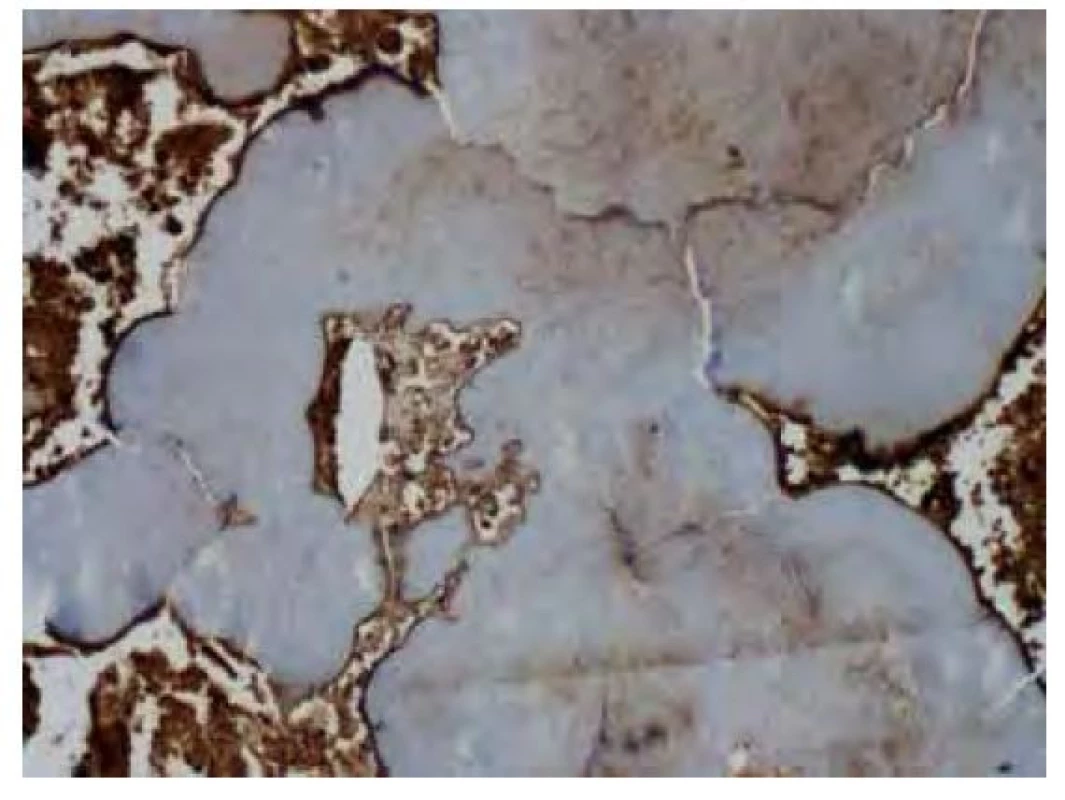 Imunohistochemické vyšetření v reakci s protilátkou proti
lehkým Ig lambda pouze s fokální slabou až středně silnou pozitivitou
v oblasti amyloidových depozit. Silnou pozitivitu vykazují plazmocytární
elementy v okolí depozit. Původní zvětšení snímku 100x