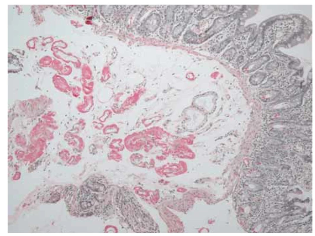 Histologický obraz duodena prokazující v drobných cévách a intersticiu
amorfní materiál, který je pozitivní v reakci na amyloid (sytě červený, barvení
saturnovou červení).<br>
Fig. 3. Histological image of the duodenum confirming amorphous material in
small vessels and interstitium that is positive for amyloid (deep red, saturn red
staining).