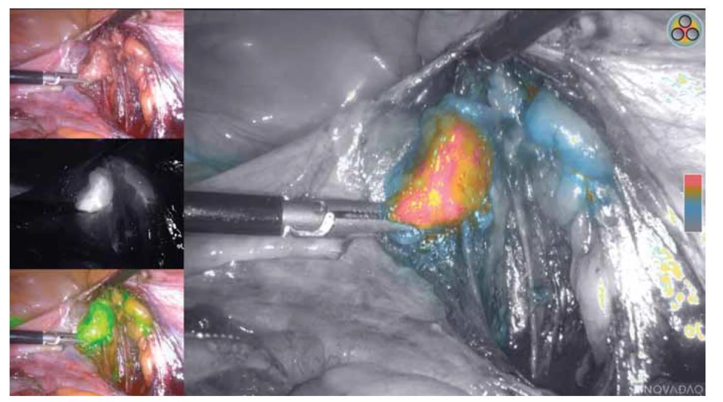 Detekce pánevní sentinelové uzliny pomocí kamery Novadaq Pinpoint.<br>
Fig. 4. Pelvic sentinel node detection using the Novadaq Pinpoint camera.