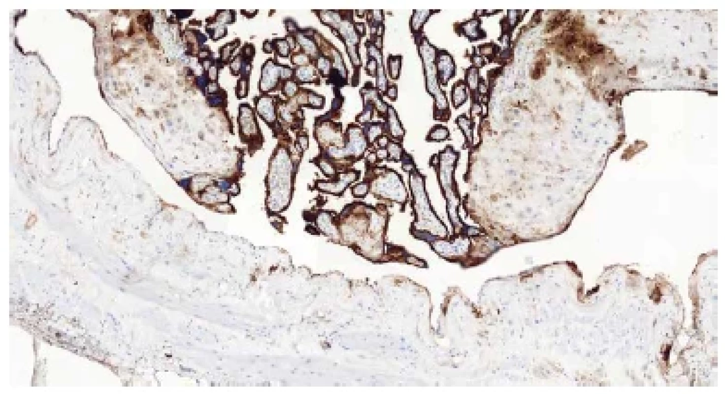 Absence bazální deciduy – negativní imunohistochemický průkaz
antigenu CD10 (CD10, 100x).