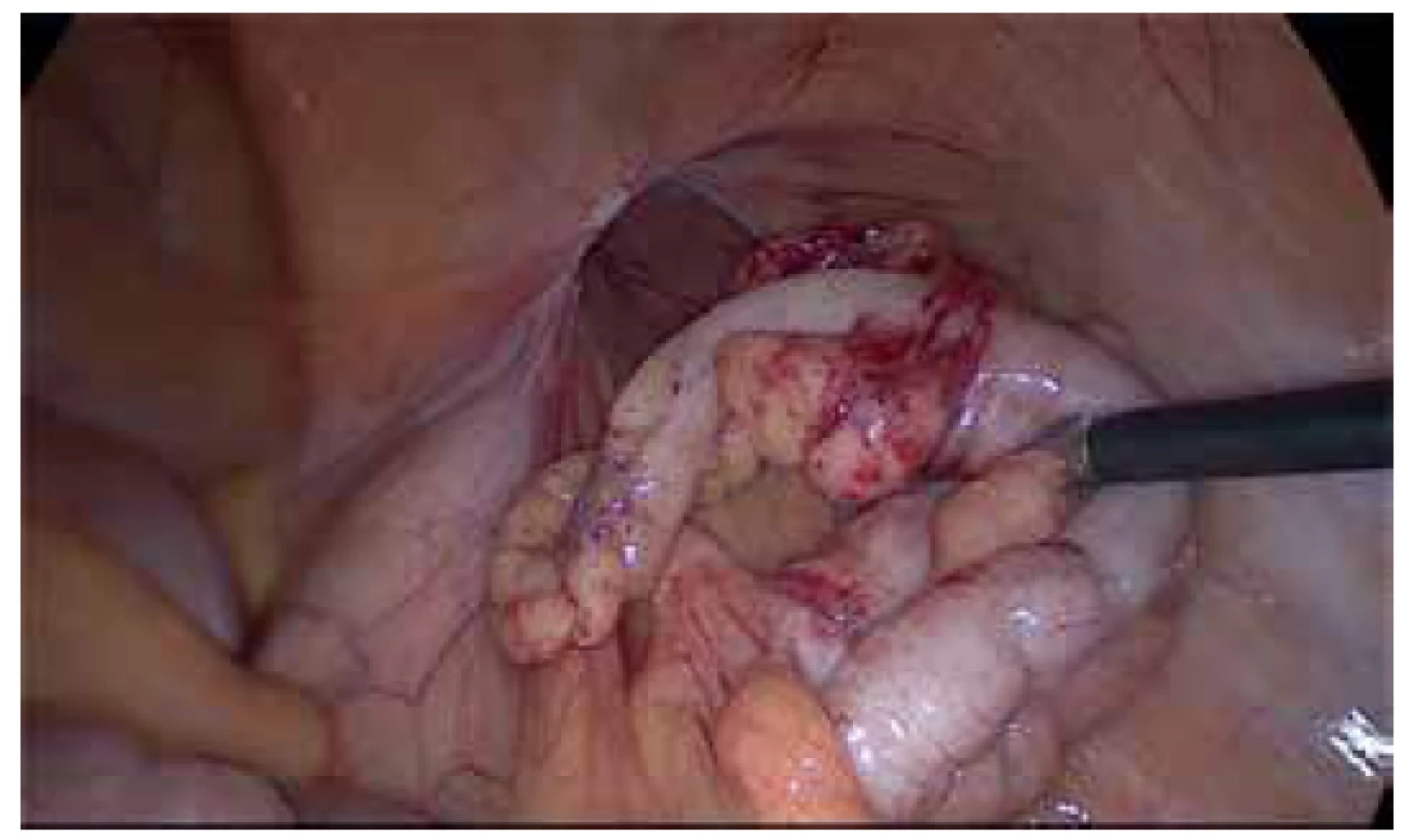 Repozice kýlního obsahu<br>
Fig. 2. Reduction of the hernia contents