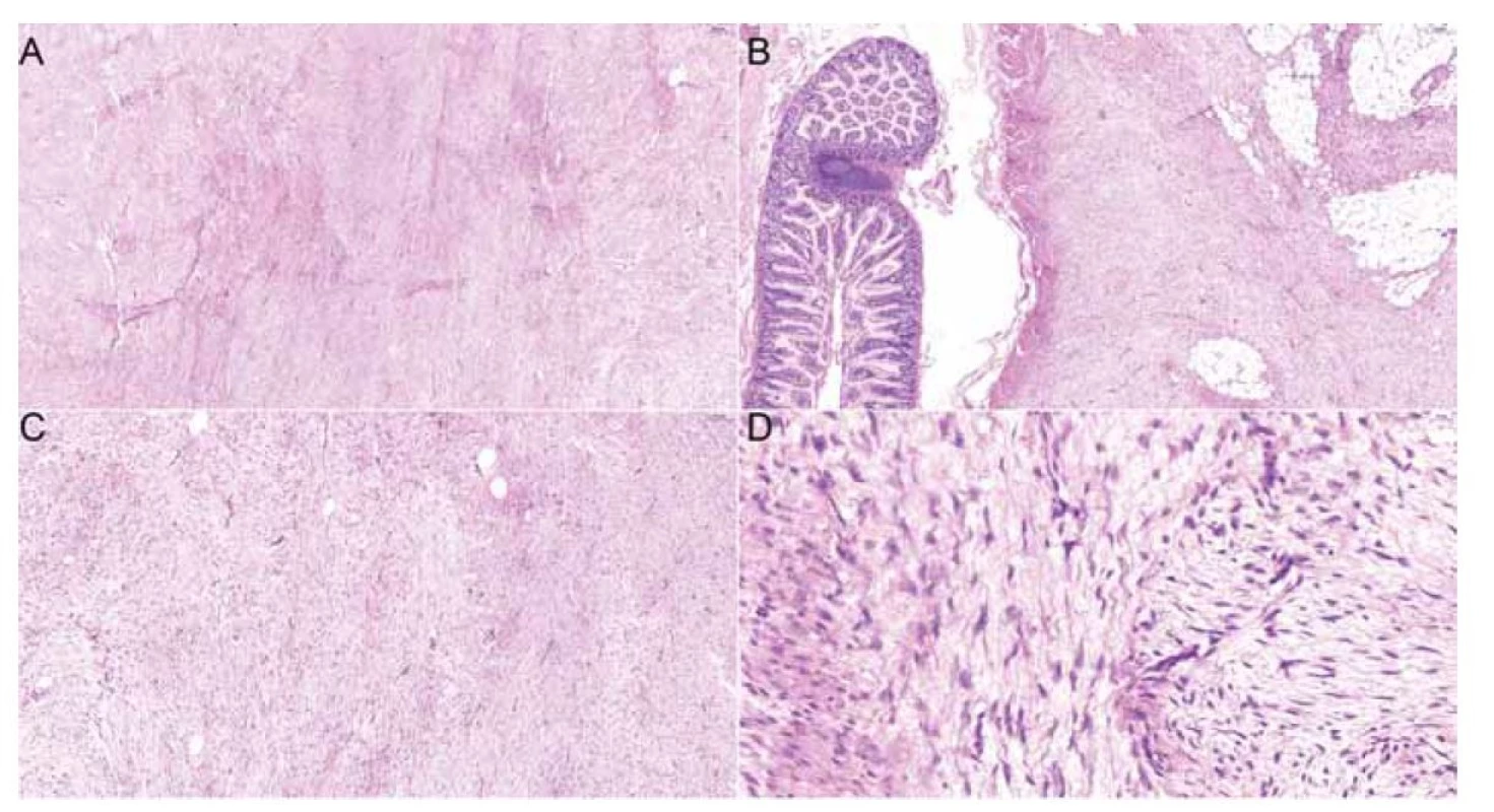 Histologické preparáty zachycující fibroblastickou/myofibroblastickou vřetenobuněčnou proliferaci vykazující
fascikulární stavbu z dlouhých buněčných svazků tzv. long sweeping fascicles, kapiláry sledují směr svazků (A: hematoxylin
eosin, 5x). Léze vykazuje infiltrativní okraje a vrůstá do hladkosvalové stěny tenkého střeva a tukové tkáně mezenteria
(B: hematoxylin eosin, 5x). Léze vykazuje nízkou buněčnost, sestává ze štíhlých vřetenitých buněk charakteru (myo)fibroblastů
(C: hematoxylin eosin, 10x). Některé buňky tvarově kopírují zvlněná kolagenní vlákna, bez cytonukleárních atypií
(D: hematoxylin, 20x).<br>
Fig. 2. Histology slides showcasing fibroblastic/myofibroblastic spindle cell proliferation exhibiting fascicular structure formed
by long cell bundles, so-called long sweeping fascicles, and capillaries following the direction of the bundles (A: hematoxylin
eosin, 5x). The tumour exhibits marginal infiltration of the small intestine smooth muscle wall and adjacent adipose mesentery tissue
(B: hematoxylin-eosin, 5x). The tumor is of low cellularity, consisting of (myo) fibroblasts (C: hematoxylin-eosin, 10x). Some cells
copy the wavy shape of collagen fibers, showing no nuclear atypia (D: hematoxylin, 20x).