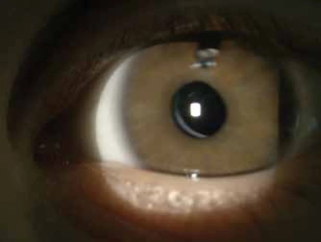 Aphakic left eye of proband at the age of 8 years.