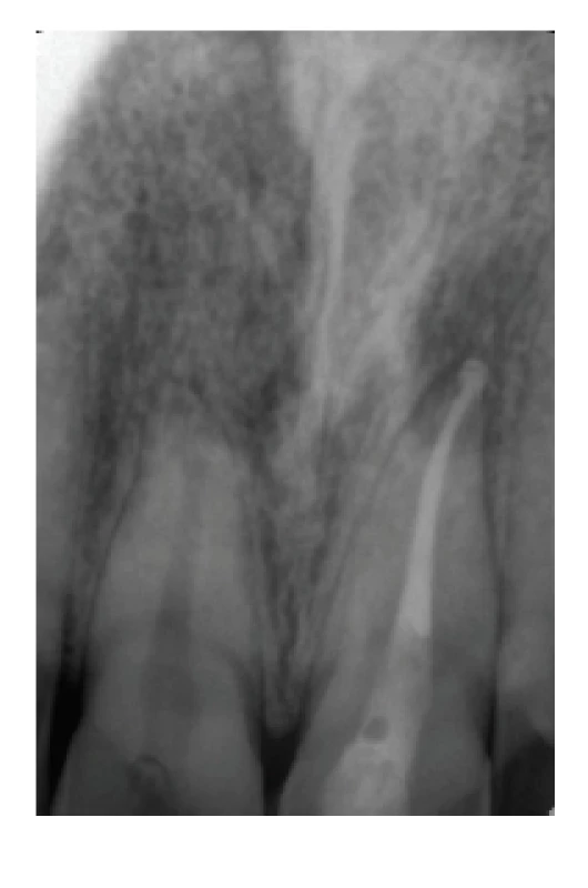 Koreňový kanálik zaplnený<br>
biokeramickým sealerom<br>
BioRoot™ RCS<br>
a gutaperčou<br>
Fig. 4<br>
Root canal obturated<br>
with bioceramic sealer<br>
BioRoot™ RCS<br>
and gutta-percha