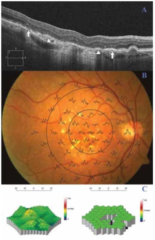 Oftalmologický nález pacienta z kontrolní skupiny.
(A) Optická koherentní tomografie pravého oka pacienta. Od
DPED se odštěpuje asymetricky elipsoidní vrstva fotoreceptorů
(), okraje jejího defektu jsou označeny pomocí šipek. (B)
Superpozice mfERG odpovědí na fundu pravého oka pacienta.
Reziduální foveolární a parafoveolární aktivita. (C) Trojrozměrný
obraz mfERG. Vlevo: obraz elektrické aktivity sítnice pravého
oka s chybějící foveolární odpovědí; vpravo porovnání s věkovou
normou (pokles foveolární, parafoveolárních a části paramakulárních
odpovědí)