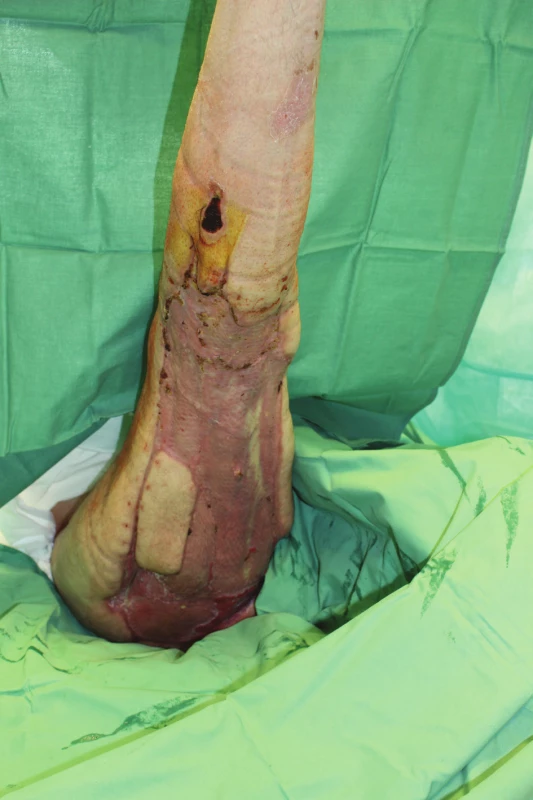 16. den po transplantaci, štěpy přihojeny, 2 malé
granulační plošky<br>
Fig. 6: 16 days after autografting, grafts healed in, 2 small
residual granulation areas
