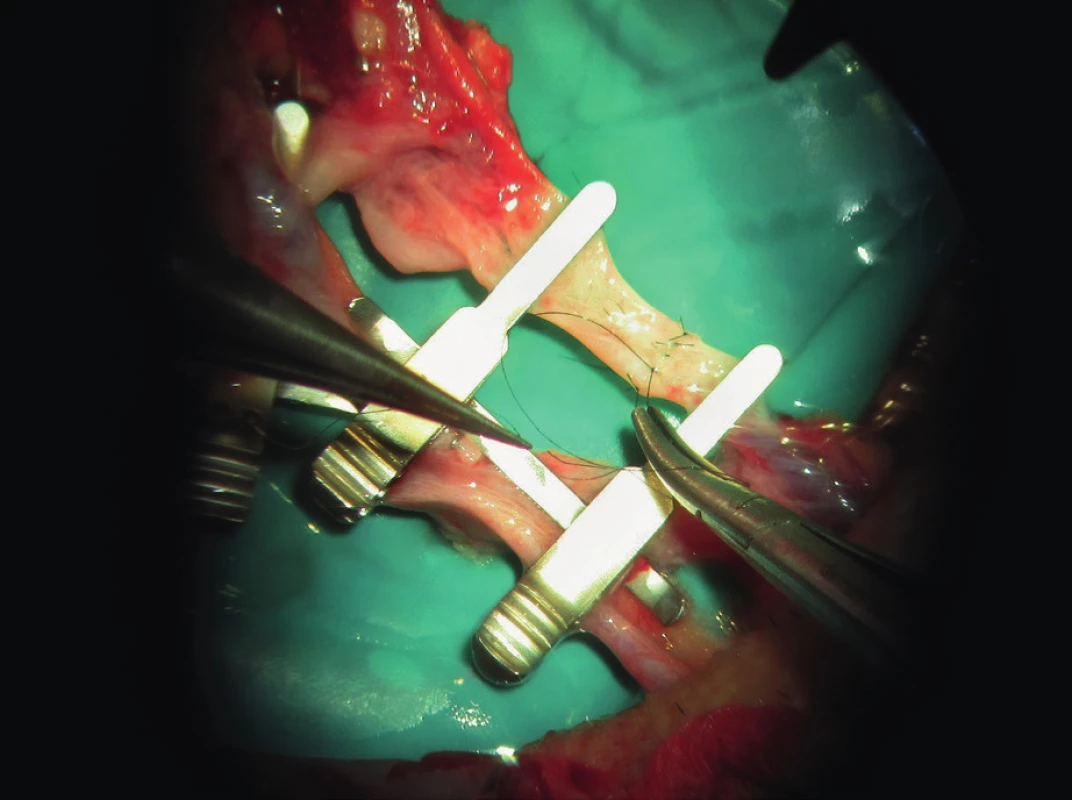 The surgeon´s experience and quality operative technique are major factors of success (archive of the author)