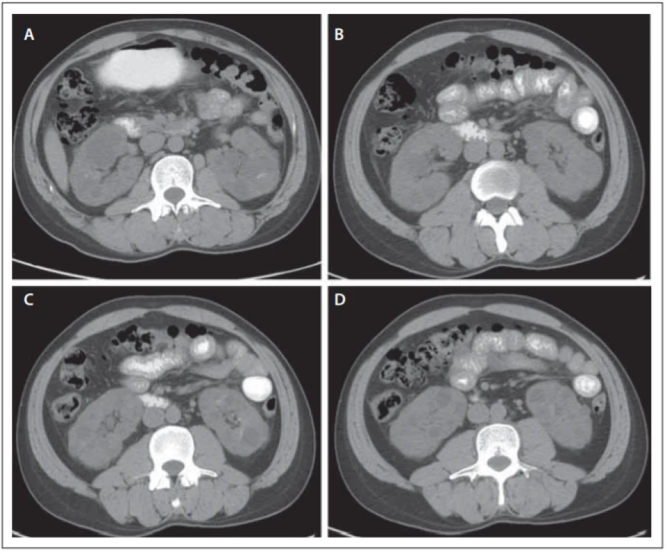 Abdominal CT images. Bilateral renal polycystosis.<br>
Obr. 2. CT snímky břišní dutiny. Polycystóza ledvin oboustranně.