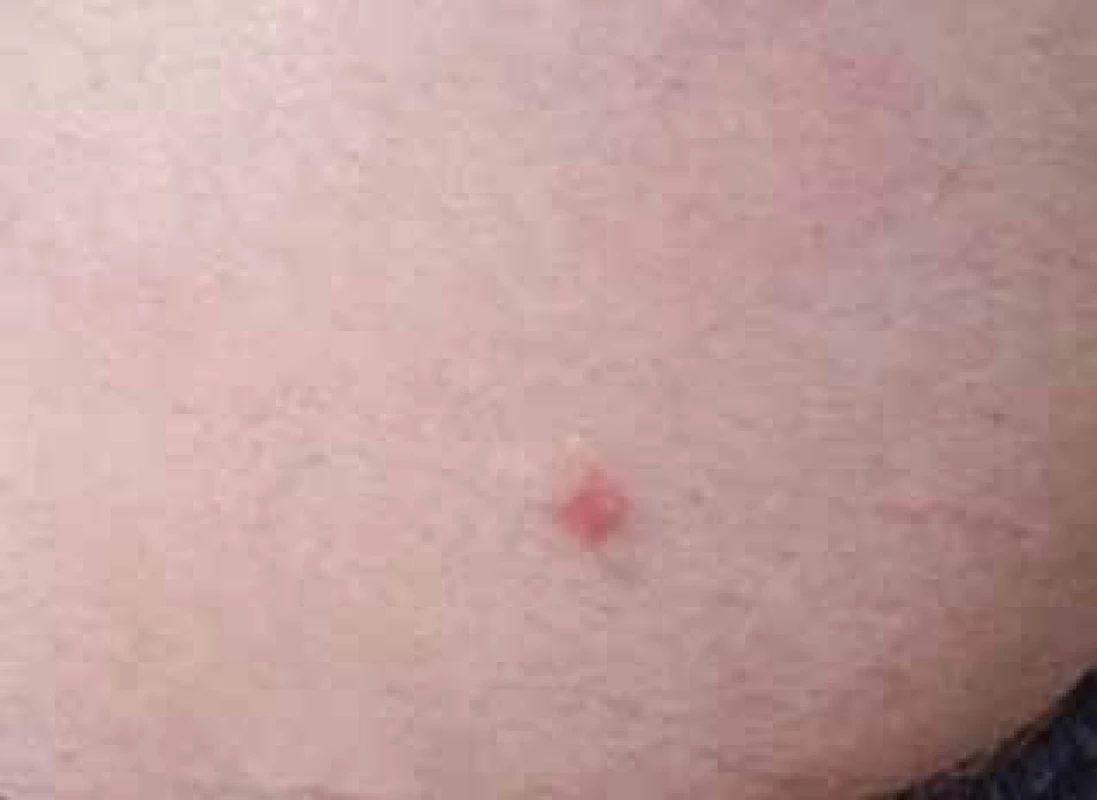 Kožná larva migrans v gluteálnej oblasti