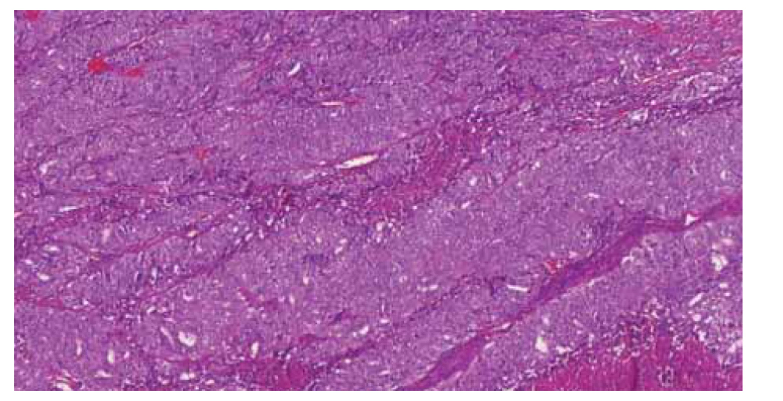 Špatně diferencovaný endometriální adenokarcinom (grade 3), mající
mutace v genu POLE (c.1376C>T), p.(Ser459Phe).<br>
Fig. 2. Poorly differentiated endometrial adenocarcinoma (grade 3) with mutations
in the POLE gene (c.1376C> T), p. (Ser459Phe).