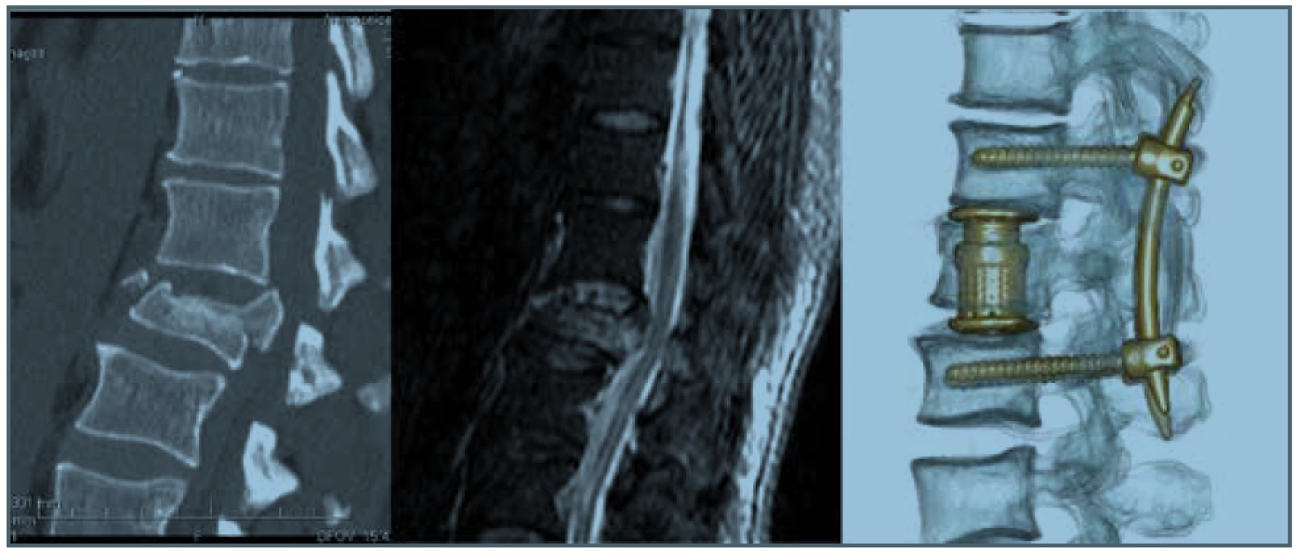 Tříštivá zlomenina L1 (A4) s obstrukcí v páteřním kanále a syndromem kaudy (N3) TL AOSIS – 9,
řešena kombinovanou krátkou instrumentací<br>
Fig. 3. Burst fracture of L1 (A4) with spinal cannal obstruction and cauda equina injury (N3) TL AOSIS – 9,
treated by short combined instrumentation