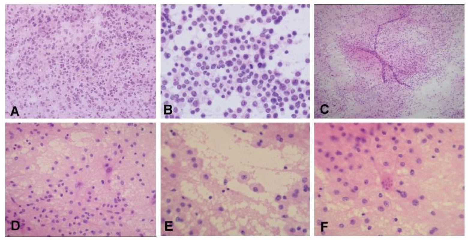 (A, B) Periventrikulárny tumor u 75-ročnej ženy. V zmrazenom reze jasná nádorová infiltrácia, typ nádoru však nemožno spoľahlivo stanoviť (A). V náterovej
cytológii bola zachytená diskohezívna lymfoidná populácia buniek, niektoré iba s nahými jadrami, iné s tenkým lemom cytoplazmy. Na pozadí početné
tzv. lymfoglandulárne telieska - fragmenty cytoplazmy po rozpade buniek. Jadrá majú vzhľad prevažne centrocytrov (B). Peroperačná diagnóza: high-grade
lymfóm. Definitívna diagnóza: difúzny veľkobunkový B-lymfóm (DLBCL). (C-F) Supratentoriálne ložisko u 21-ročnej ženy. Náter bol na prvý pohľad celulárny
a pôsobil „nádorovo“ (C). Pri bližšom pohľade ale bolo jasné, že sa jedná o heterogénnu populáciu buniek, ktorá je tvorená reaktívnymi astrocytmi s jemnými
pravidelnými dlhými výbežkami, malými lymfocytmi a makrofágmi s objemnou svetlou jemne granulárnou cytolplazmou (D, E). V ložiskách demyelinizácie (ale
aj iných procesoch s reaktívnou astrocytózou) sa často vyskytujú neobvyklé astrocyty s fragmentovaným jadrom – tzv. Creutzfeldtove bunky (F). Peroperačná
diagnóza: akútna zápalová demyelinizácia, jednoznačný nádor nie je prítomný. Definitívna diagnóza: ložisko aktívnej demyelinizácie sugestívne pre diagnózu
sclerosis multiplex.