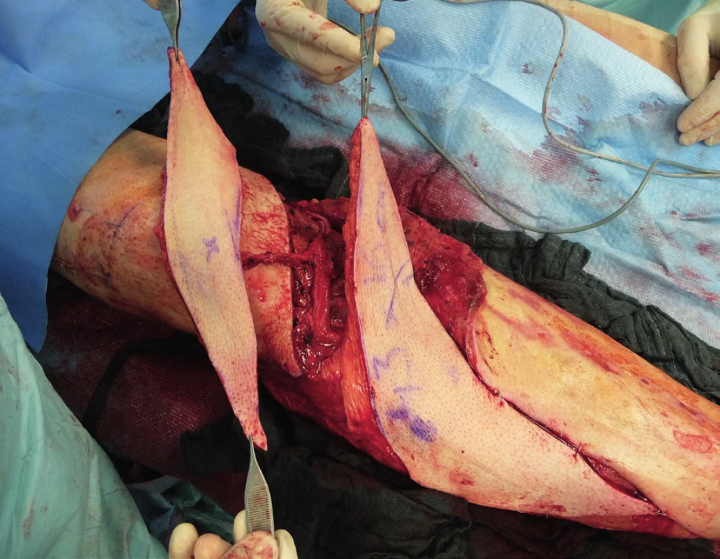 Because of the advantage of satisfactory soft tissue on
the thigh, the ALT flap was chosen. It was harvested as a twocomponent
flap consisting of muscle and skin parts (divided
into two parts). The size of ALT flap was 43 x 16 cm covering the
entire length of exposed tibia and tibia fixation plate