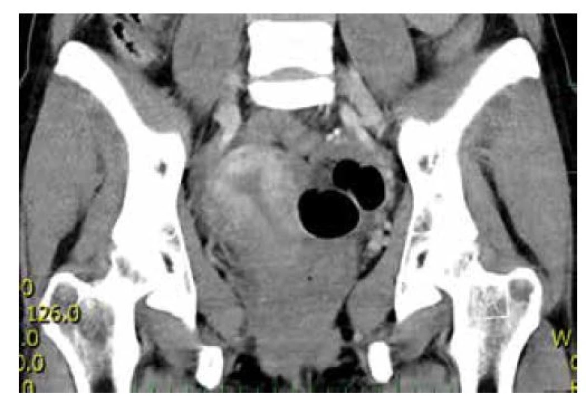 CT s dělohou deviovanou doprava a uskřinutým ileem<br>
Fig. 4: CT with the uterus deviated to the right and incarcerated
ileum