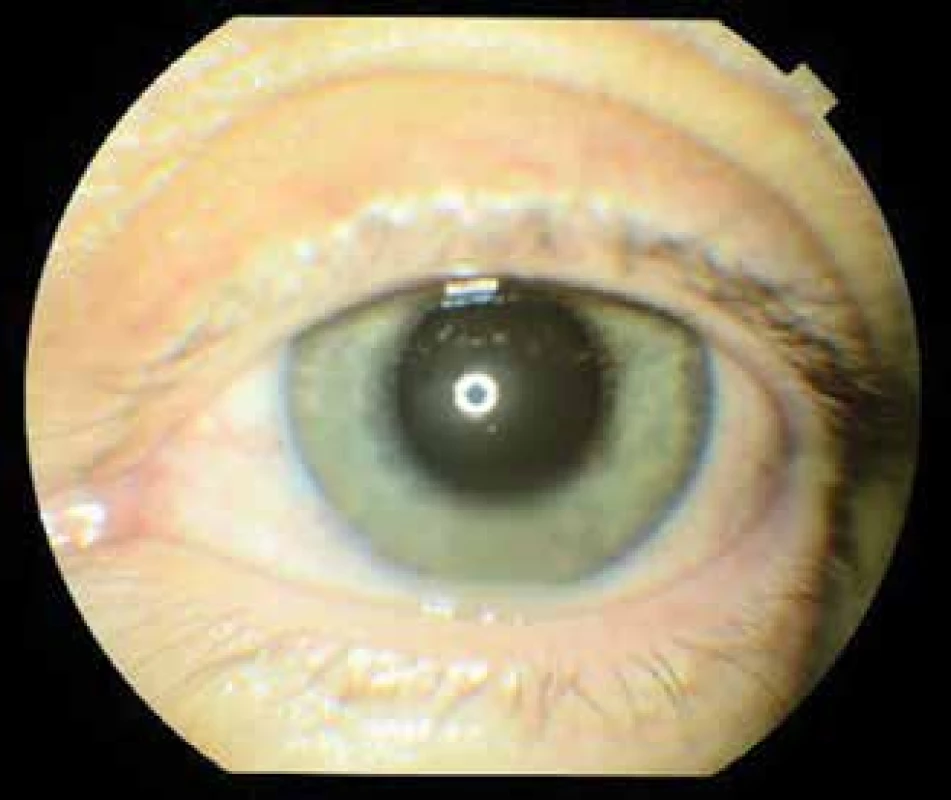 Left eye at 1st examination, hyperaemia of conjunctiva,
precipitates on cornea, Tyndall effect in anterior
chamber, hypopyon, hyperaemia of iris