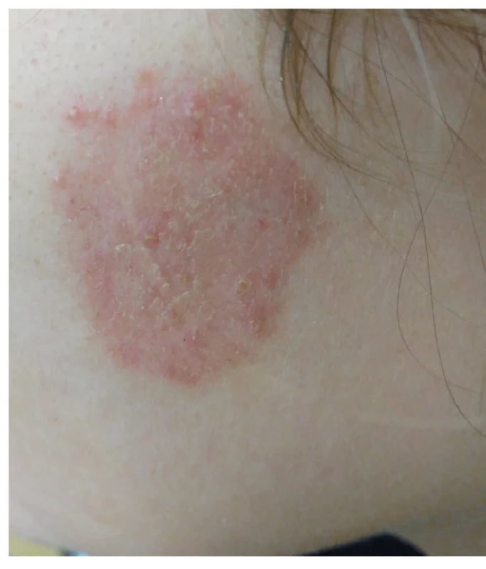 Tinea facei vyvolaná Trichophyton erinacei
u pacientky 1 – oploštělé ložisko po devíti dnech lokální
terapie ciklopiroxolaminem