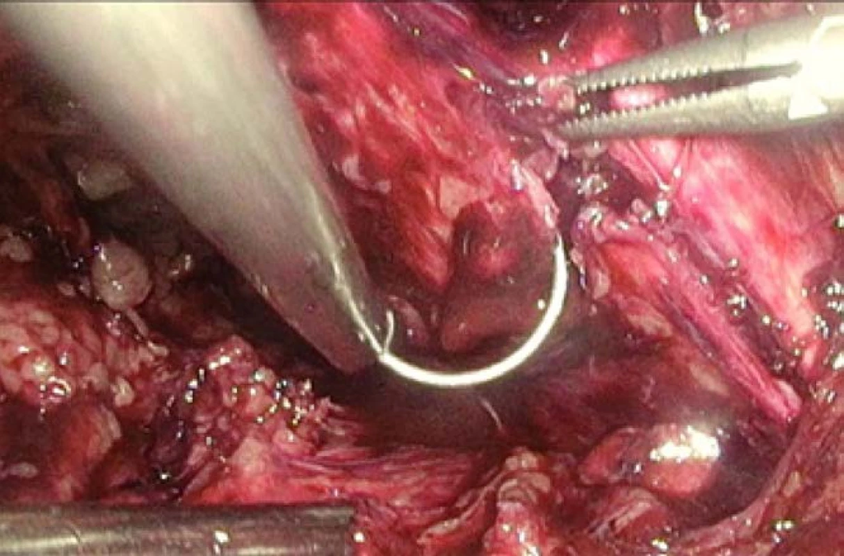Laparoskopie – horní
raménko stydké kosti vpravo
s frakturou, v kostním defektu
špička jehly, v grasperu vpravo
zachycen odlomek kosti<br>
Fig. 4. Laparoscopy – Fracture
of superior pubic ramus the
tip of the needle is in the bone
defect, a fragment of bone is in
the grasper