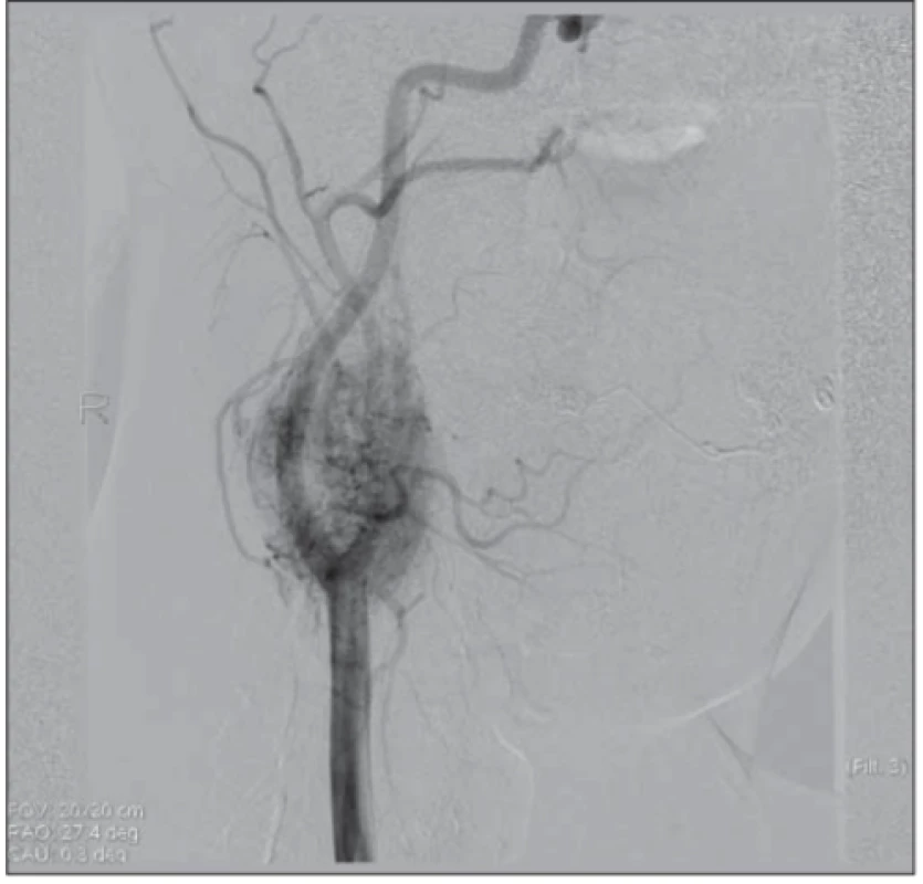 Carotid arteriography shows a strongly vascularized lesion in the right carotid bifurcation with a typical image for
paraganglioma.<br>
Obr. 2. Angiografi cký obraz ukazuje silně vaskularizované
ložisko v pravé karotické bifurkaci s typickým obrazem pro
paragangliom.