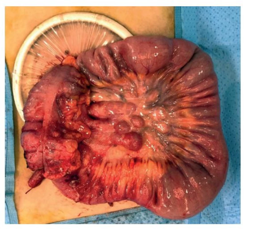 Laparoskopicky mobilizovaná ileocekální oblast
s Alexis retraktorem<br>
Fig. 1: Laparoscopically mobilized ileocecal region with
the Alexis retractor