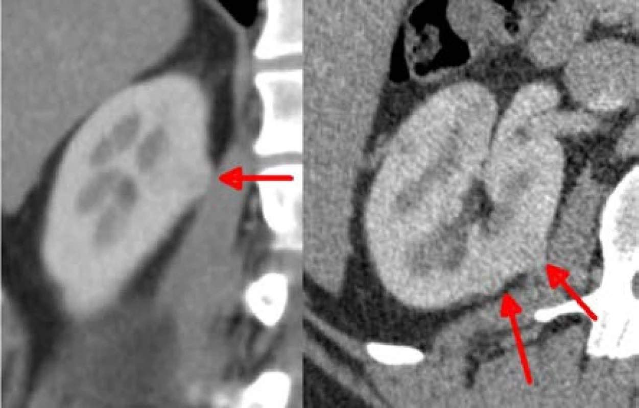 Dvě ložiska velikosti 14 a 7 mm, která byla resekována
současně, jako druhé v pořadí, bez ischemie<br>
Fig. 2. Two lesions of 14 and 7mm, which were removed
togerther as the second resection site, without ischemia
