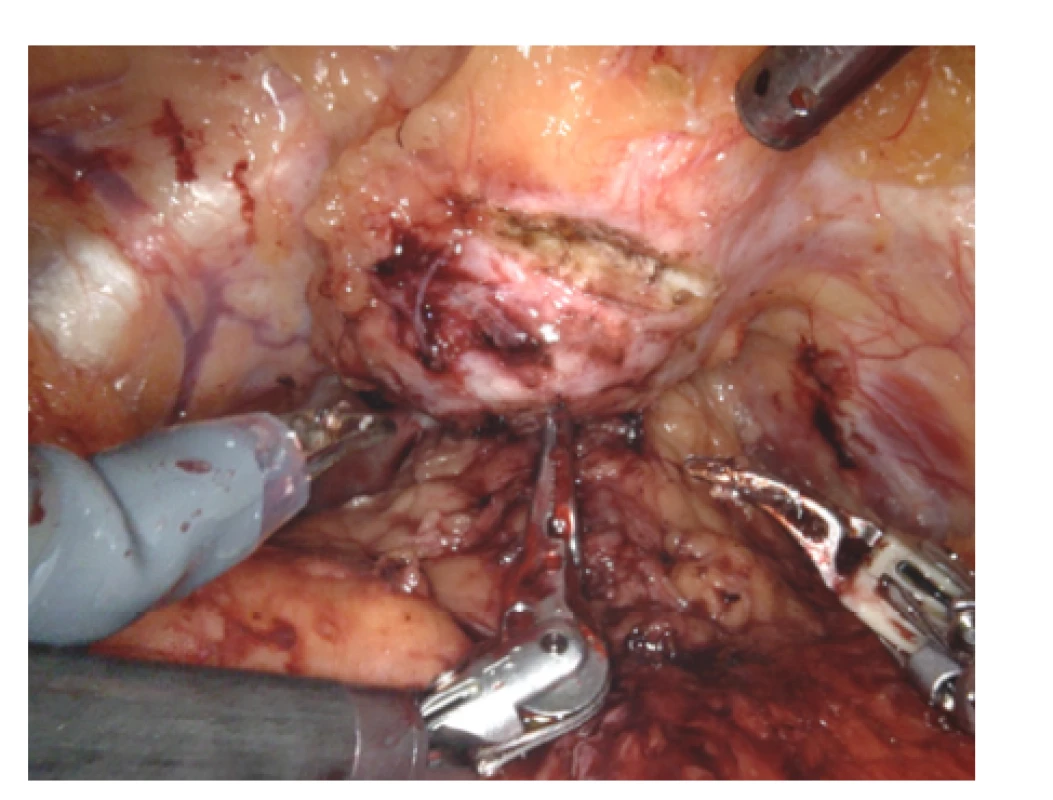 Monopolárními nůžkami zahájena incize protuberance,
která při pohmatu s grasperem (Prograsp™) balotovala<br>
Fig. 3. Incision of protuberance begins with monopolar
scissors; protuberance was relatively soft by
touching of grasper (Prograsp™)