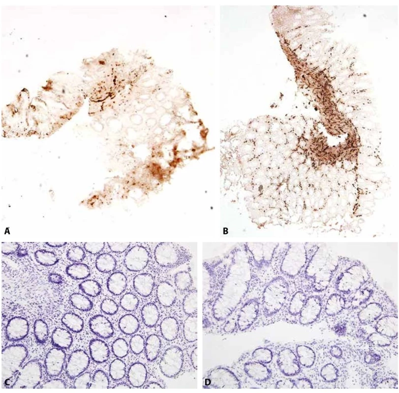 Stejný pacient s HN ve věku 14 dní (A, C) a 2 měsíců (B, D).<br>
A: Acetylcholinesterázová reakce jen slabě pozitivní v krátkém úseku muscularis mucosae, v lamina propria je reakce negativní (iso-ACHE 40x).<br>
B: Acetylcholinesterázová reakce pozitivní v muscularis mucosae i lamina propria (iso-ACHE 40x).<br>
C: Negativní imunohistochemický průkaz kalretininu (200x).<br>
D: Negativní imunohistochemický průkaz kalretininu beze změn (200x).