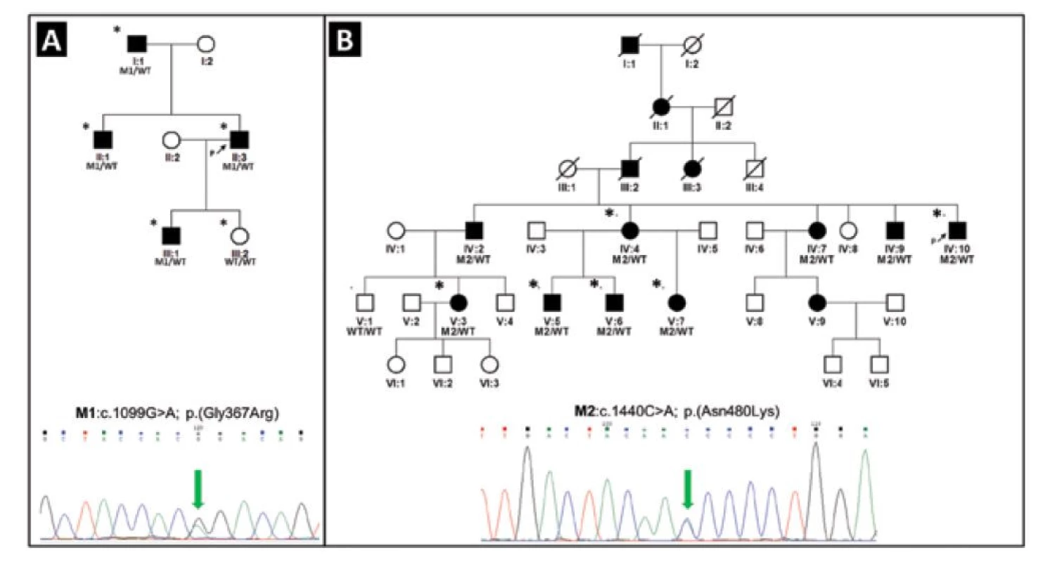 Rodokmeny dvou rodin s PGOÚ na podkladě patogenních variant v genu MYOC. Rodina č. 1 s mutací M1
c.1099G>A v heterozygotním stavu, která byla detekována u čtyř postižených jedinců (A). Rodina č. 2 s mutací M2
c.1440C>A v heterozygotním stavu, která byla prokázána u devíti postižených jedinců (B). Probandi jsou označeni černou
šipkou, jedinci klinicky vyšetřeni alespoň jedním z autorů hvězdičkou, černé kolečko označuje ženu s PGOÚ, černý
čtvereček muže s PGOÚ. Výsledky genetického testování genu MYOC jsou ukázány pouze u molekulárně geneticky
vyšetřených jedinců. Všichni prokázaní nositelé patogenních variant vykazovali známky PGOÚ (diagnóza PGOÚ u jedinců,
kteří nebyli vyšetřeni na našem pracovišti [tj. IV:2, IV:7, IV:9] byla stanovena na jiném pracovišti, což bylo ověřeno na
základě dostupných lékařských zpráv). WT označuje referenční sekvenci (anglicky „wild type“)