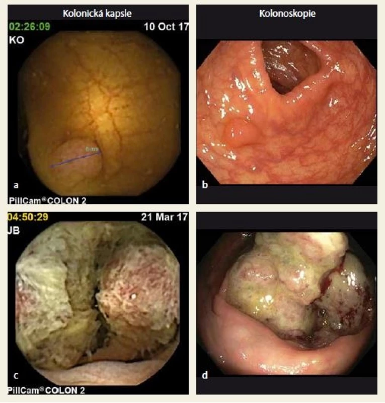 Porovnání nálezů na kolonické kapsli a optické kolonoskopii (a + b polyp, c + d karcinom). Zdroj: archiv Oddělení gastrointestinální endoskopie ÚVN.<br>
Fig. 2. Comparison of lesions found on capsule endoscopy and optical colonoscopy (a + b polyp, c + d cancer). Source: Department of Gastrointestinal Endoscopy of Military University Hospital.