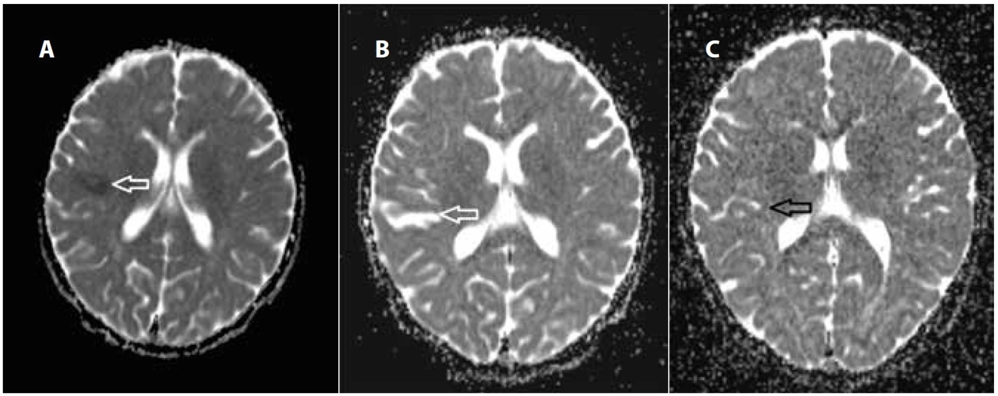 Magnetická rezonance, ADC (aparentní difuzní koeficient) mapa difuzně vážených skenů: a) restrikce v difuzi, nález odpovídá
cytotoxickému edému při ischémii; b) za 2 týdny s obnovenou difuzí v místě poškození tkáně, reparační procesy; c) za 4 měsíce
za bez zvláštností v hodnocení omezení difuze ve zhojené tkáni.
Fig. 3. Magnetic resonance imaging, ADC (transparent diffusion coefficient) map of diffusion-weighted imaging: a) initial scan
– the hyposignal area is the restriction in diffusion, the sign corresponds to cytotoxic oedema in ischemia; b) in two weeks with
restored diffusion at the site of tissue damage, repair processes; c) after four months with no pathological findings in the evaluation
of the diffusion – it corresponds to rearranged tissue with gliosis.