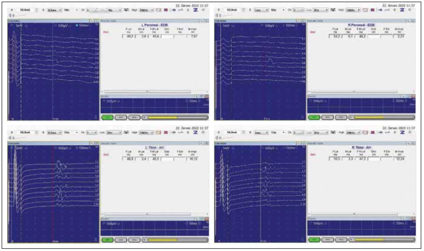 EMG. Hodnocení latencí F-vln. <br> 
Fig. 6 Evaluation of F-wave latency.